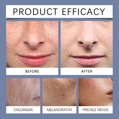 OUHOE Facial Dark Spot Cream: Fades dark spots, brightens skin tone, moisturizes and nourishes, hydrates and softens the skin-OKL