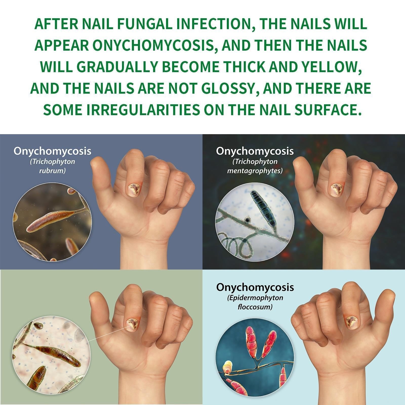 ✨ Clear Your Nail Fungus in Just 7 Days! ✨-EDC - cartographermarket